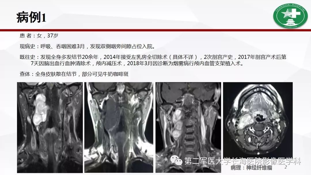 【病例】I型神经纤维瘤病及其相关肿瘤的影像学表现