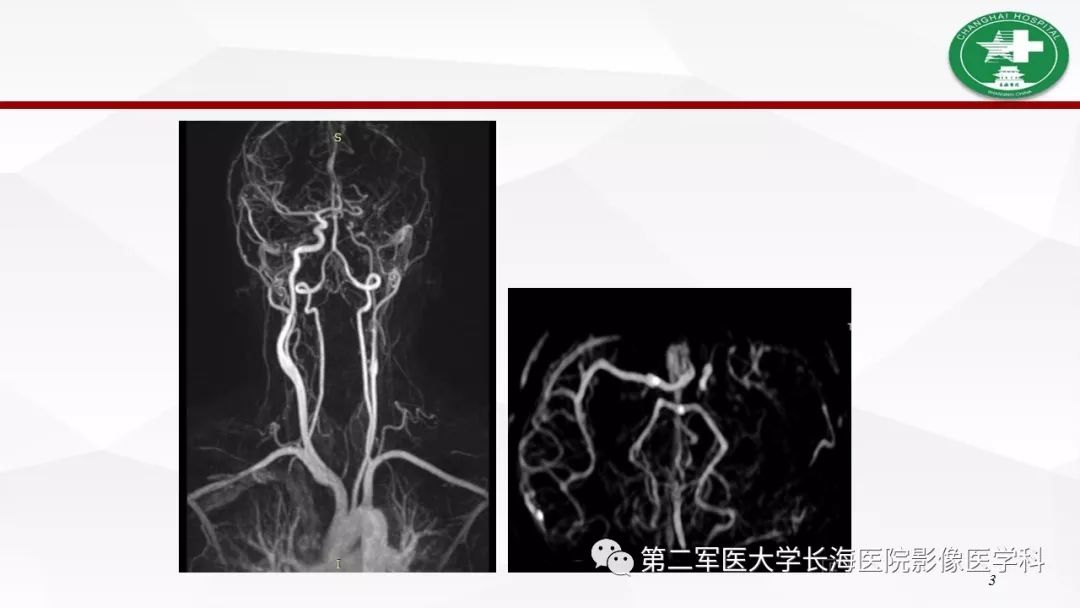 【病例】I型神经纤维瘤病及其相关肿瘤的影像学表现
