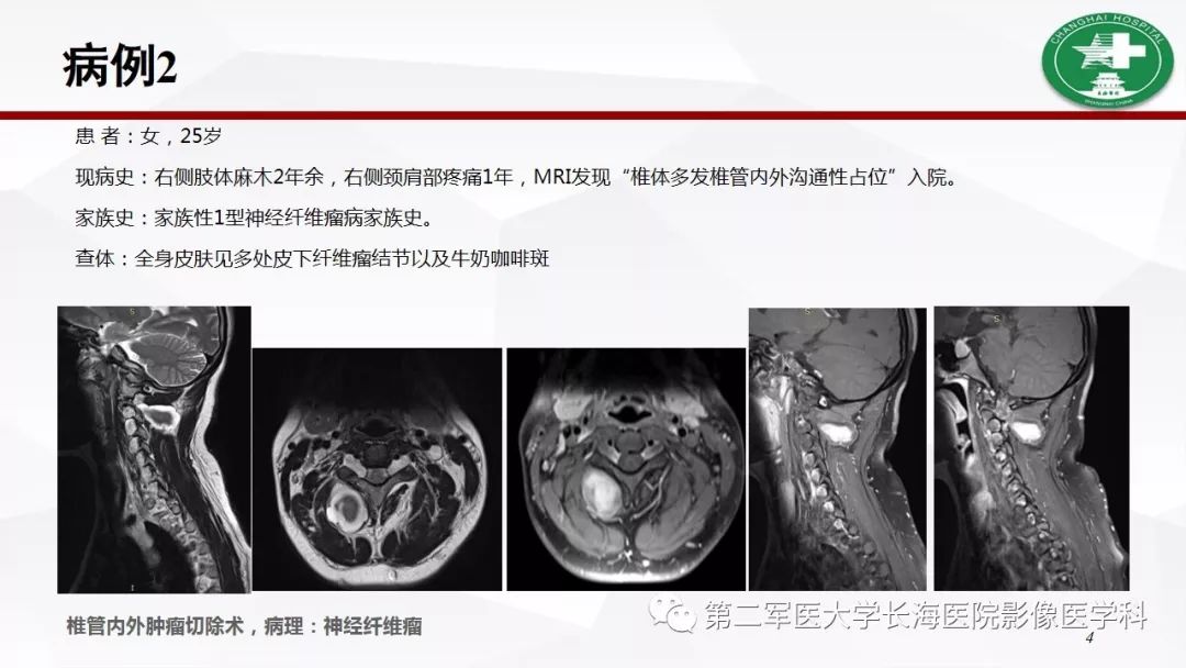 【病例】I型神经纤维瘤病及其相关肿瘤的影像学表现