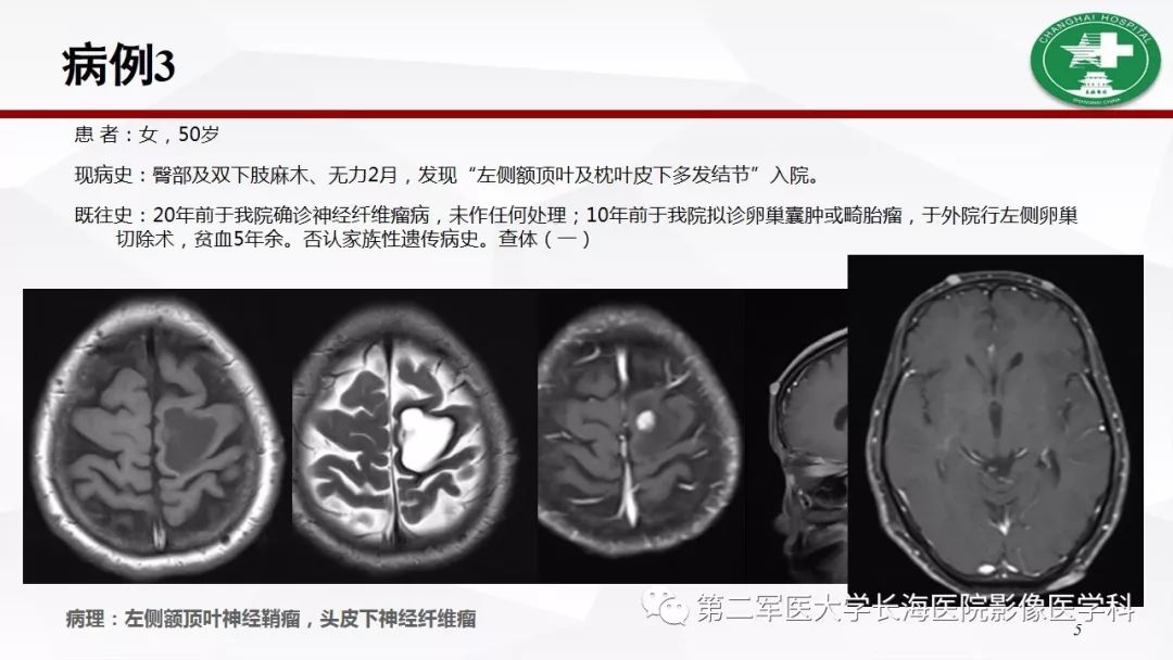 【病例】I型神经纤维瘤病及其相关肿瘤的影像学表现