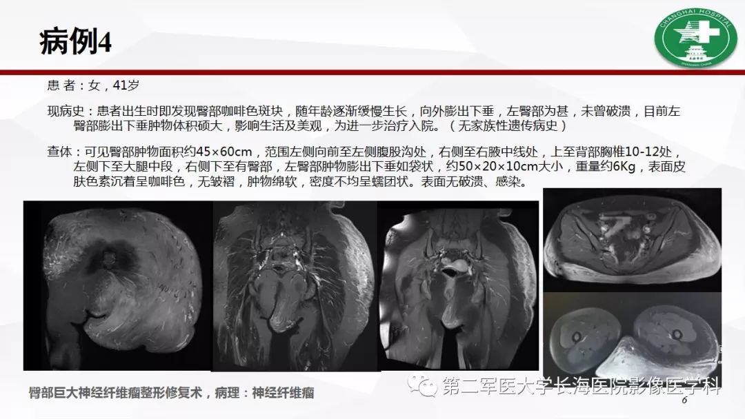 【病例】I型神经纤维瘤病及其相关肿瘤的影像学表现