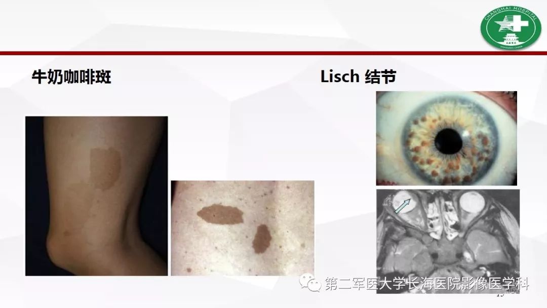 【病例】I型神经纤维瘤病及其相关肿瘤的影像学表现