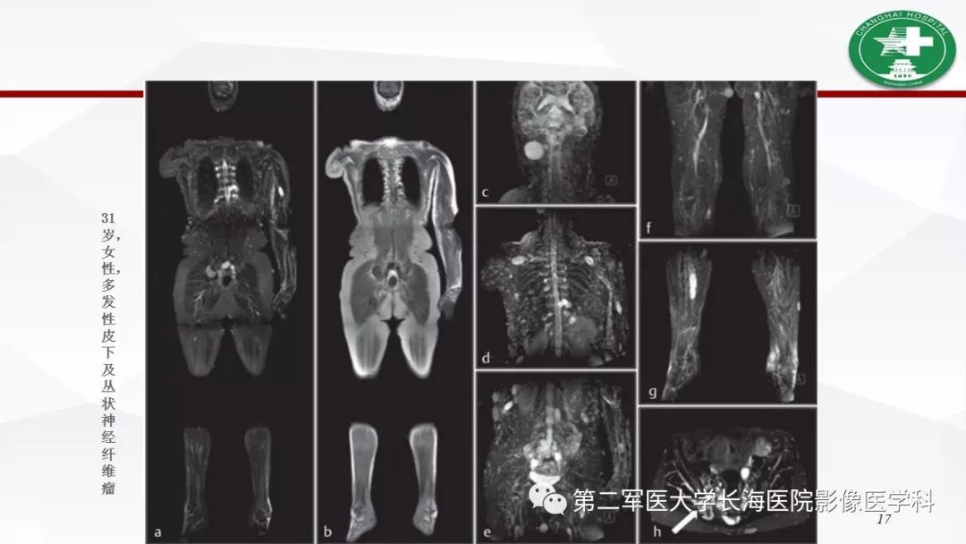 【病例】I型神经纤维瘤病及其相关肿瘤的影像学表现