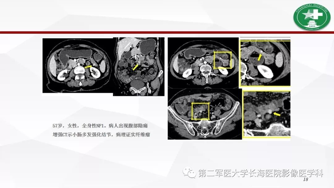 【病例】I型神经纤维瘤病及其相关肿瘤的影像学表现