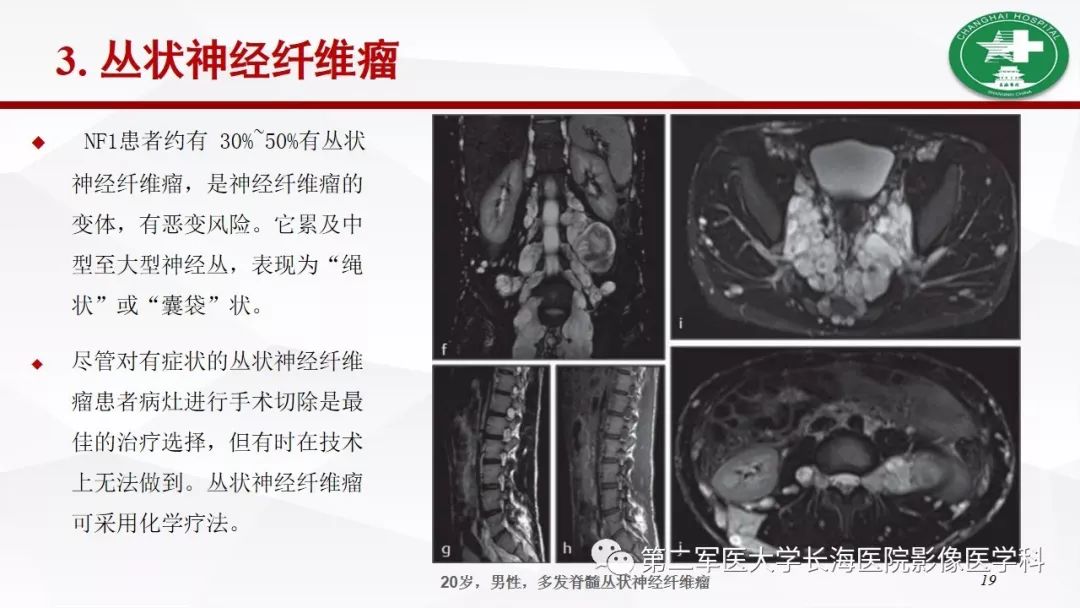 【病例】I型神经纤维瘤病及其相关肿瘤的影像学表现