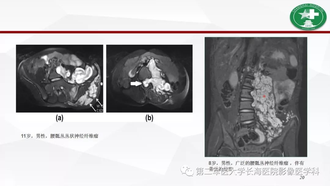 【病例】I型神经纤维瘤病及其相关肿瘤的影像学表现