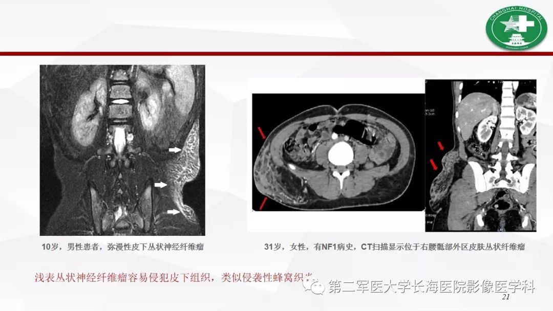 【病例】I型神经纤维瘤病及其相关肿瘤的影像学表现
