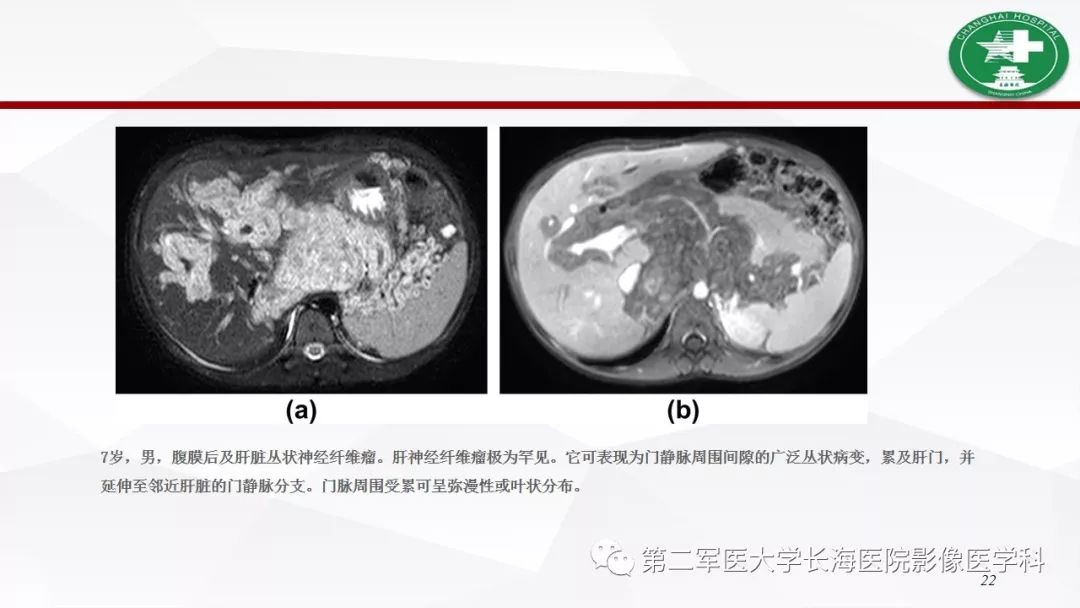 【病例】I型神经纤维瘤病及其相关肿瘤的影像学表现