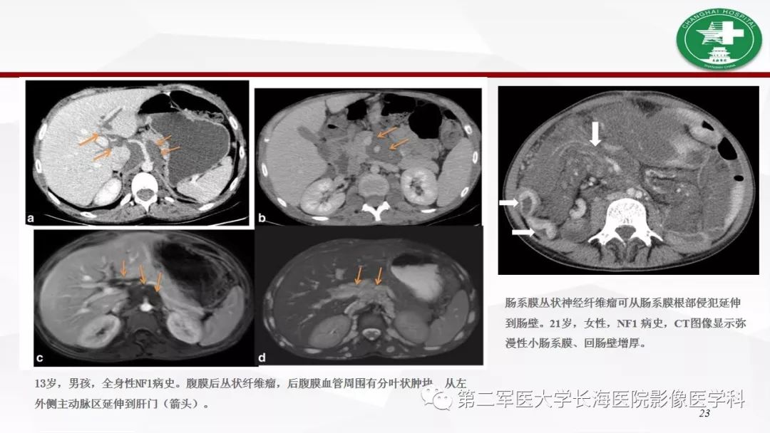 【病例】I型神经纤维瘤病及其相关肿瘤的影像学表现