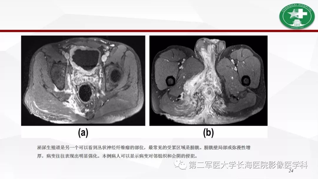 【病例】I型神经纤维瘤病及其相关肿瘤的影像学表现