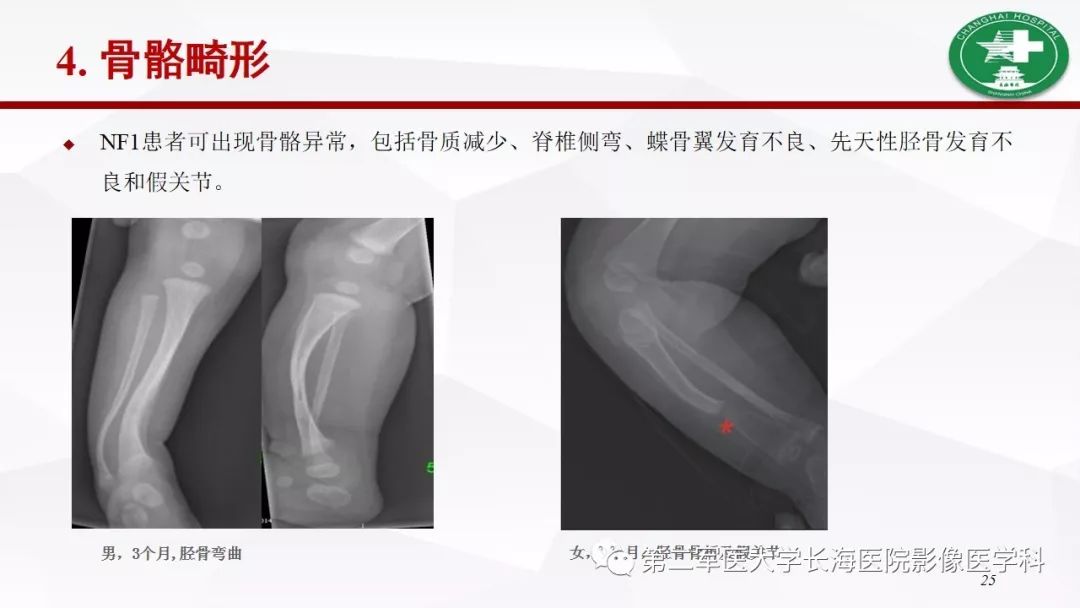 【病例】I型神经纤维瘤病及其相关肿瘤的影像学表现