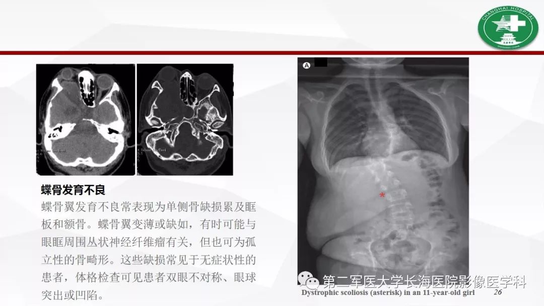 【病例】I型神经纤维瘤病及其相关肿瘤的影像学表现