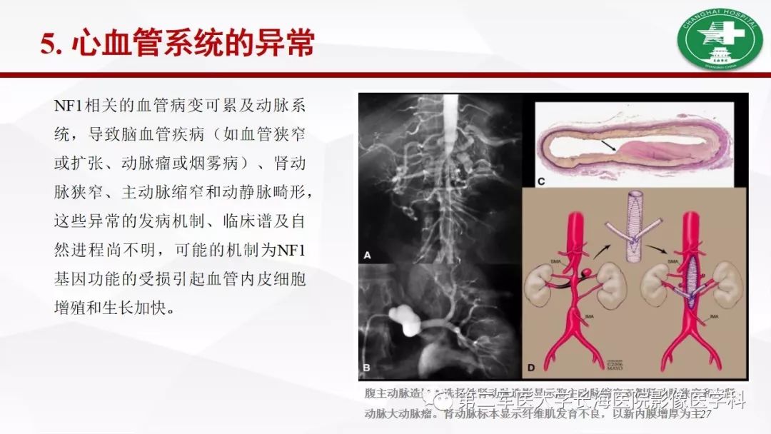 【病例】I型神经纤维瘤病及其相关肿瘤的影像学表现