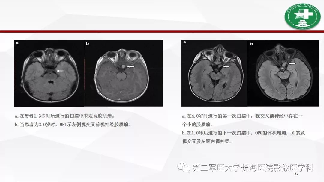 【病例】I型神经纤维瘤病及其相关肿瘤的影像学表现
