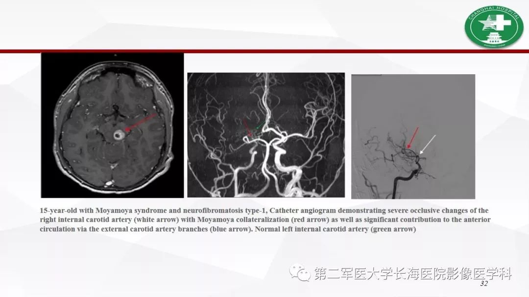 【病例】I型神经纤维瘤病及其相关肿瘤的影像学表现