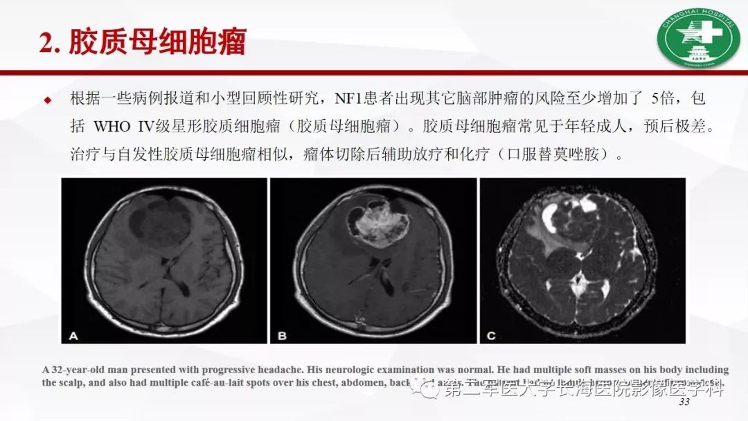 【病例】I型神经纤维瘤病及其相关肿瘤的影像学表现