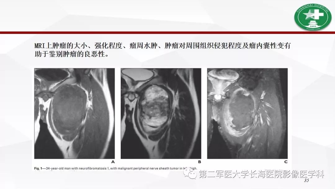 【病例】I型神经纤维瘤病及其相关肿瘤的影像学表现