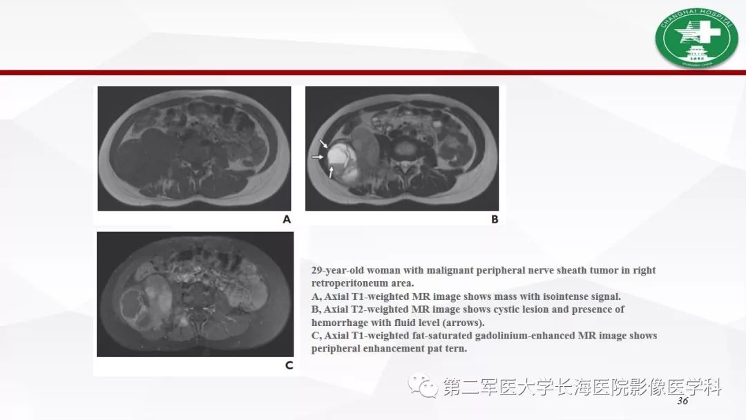 【病例】I型神经纤维瘤病及其相关肿瘤的影像学表现