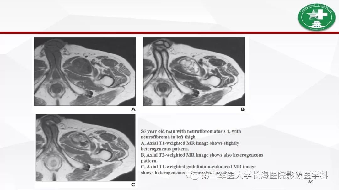 【病例】I型神经纤维瘤病及其相关肿瘤的影像学表现