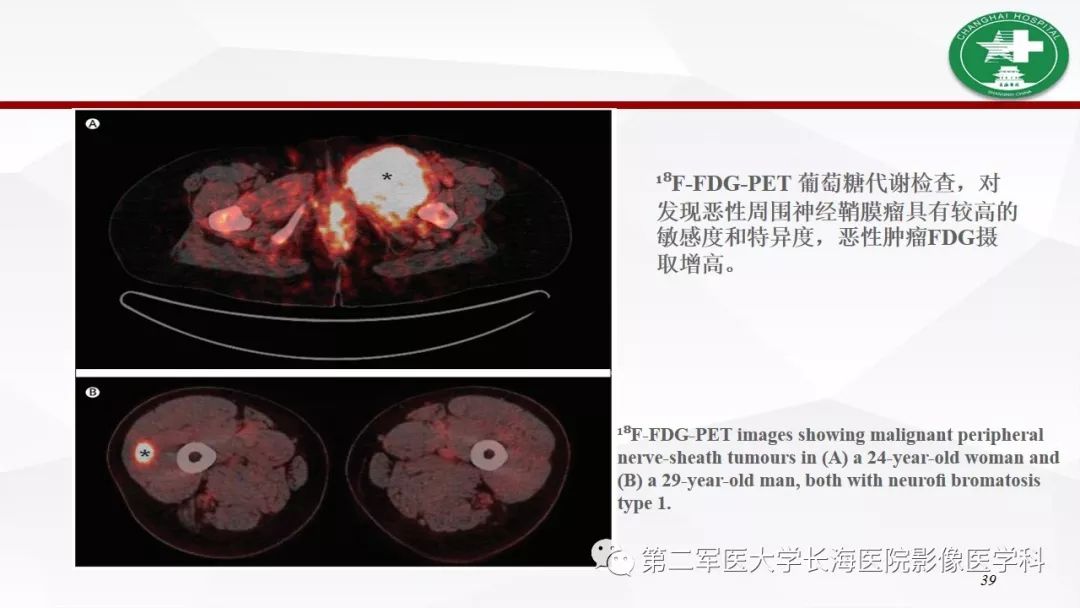 【病例】I型神经纤维瘤病及其相关肿瘤的影像学表现