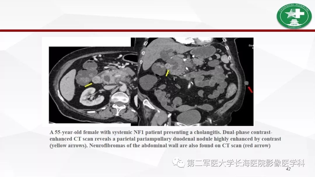 【病例】I型神经纤维瘤病及其相关肿瘤的影像学表现