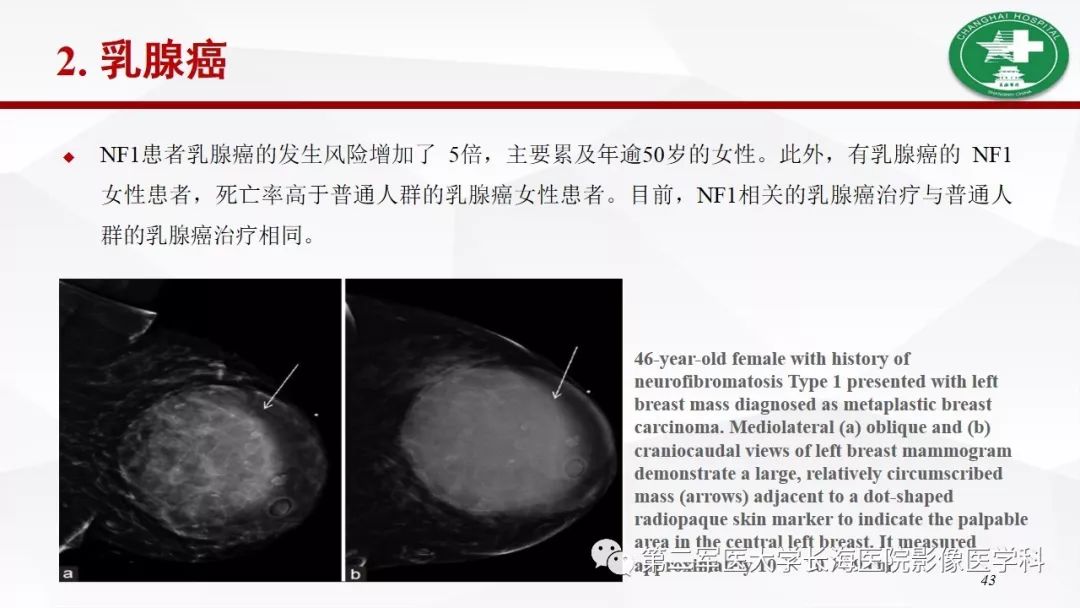 【病例】I型神经纤维瘤病及其相关肿瘤的影像学表现