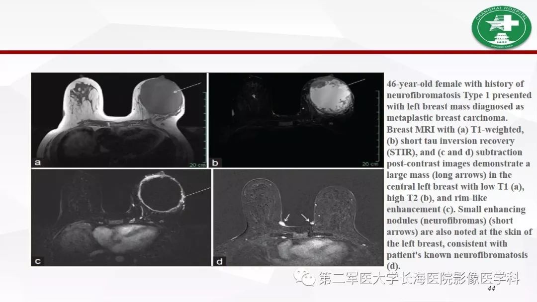 【病例】I型神经纤维瘤病及其相关肿瘤的影像学表现
