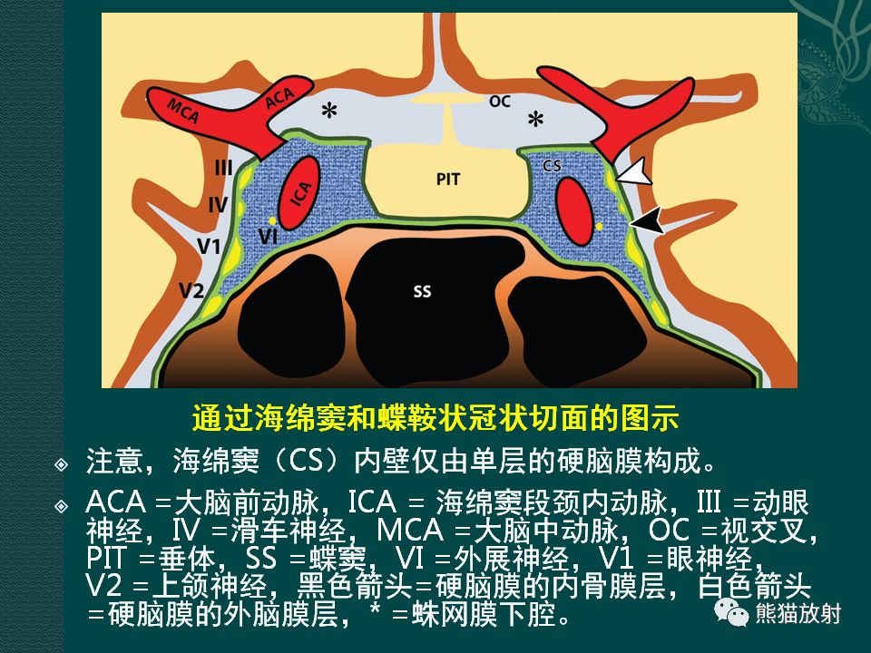 【PPT】海绵窦病变的影像表现及鉴别诊断