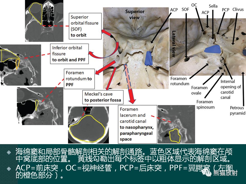 【PPT】海绵窦病变的影像表现及鉴别诊断