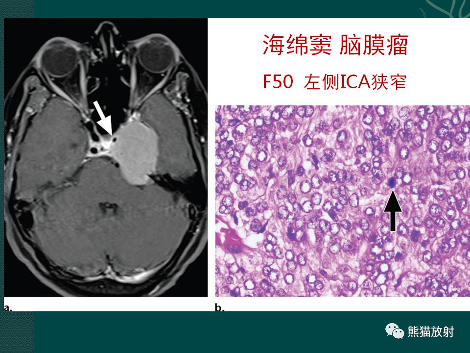 【PPT】海绵窦病变的影像表现及鉴别诊断