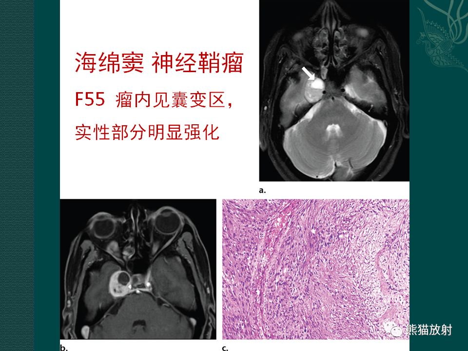 【PPT】海绵窦病变的影像表现及鉴别诊断