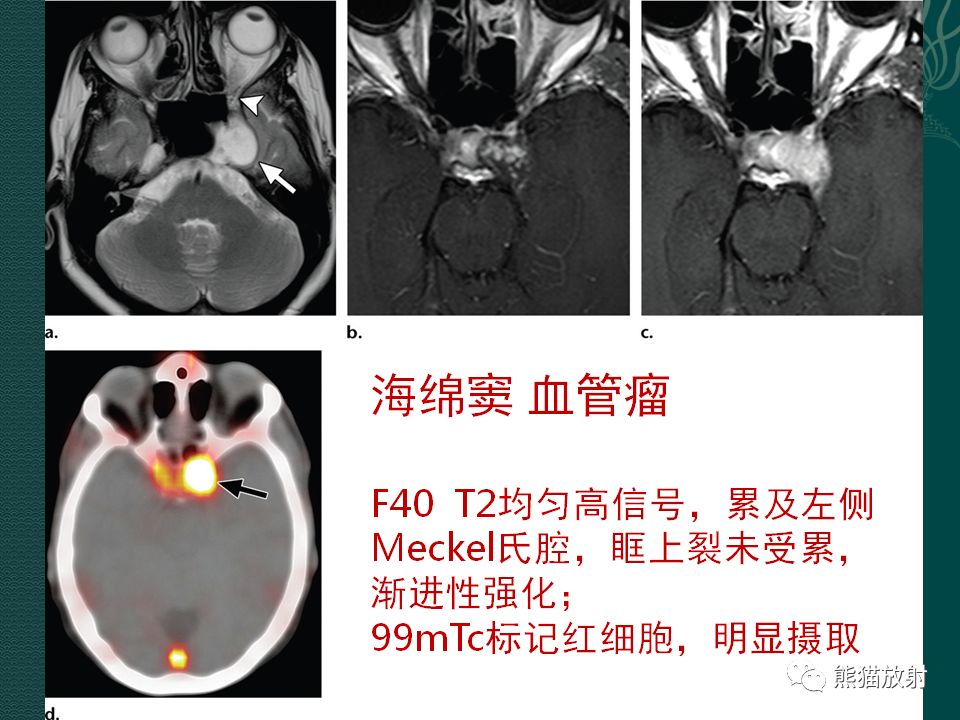 【PPT】海绵窦病变的影像表现及鉴别诊断