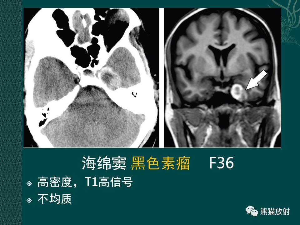 【PPT】海绵窦病变的影像表现及鉴别诊断