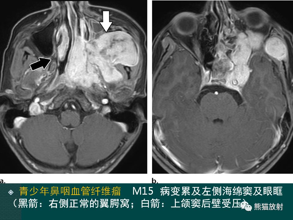 【PPT】海绵窦病变的影像表现及鉴别诊断