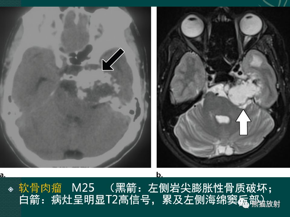【PPT】海绵窦病变的影像表现及鉴别诊断