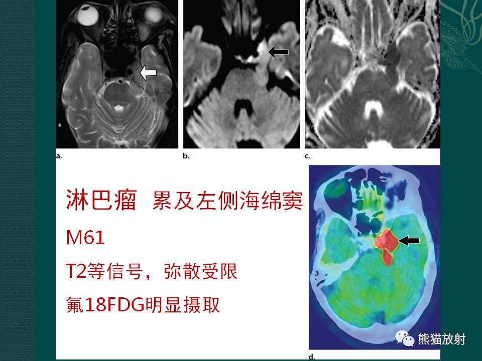 【PPT】海绵窦病变的影像表现及鉴别诊断