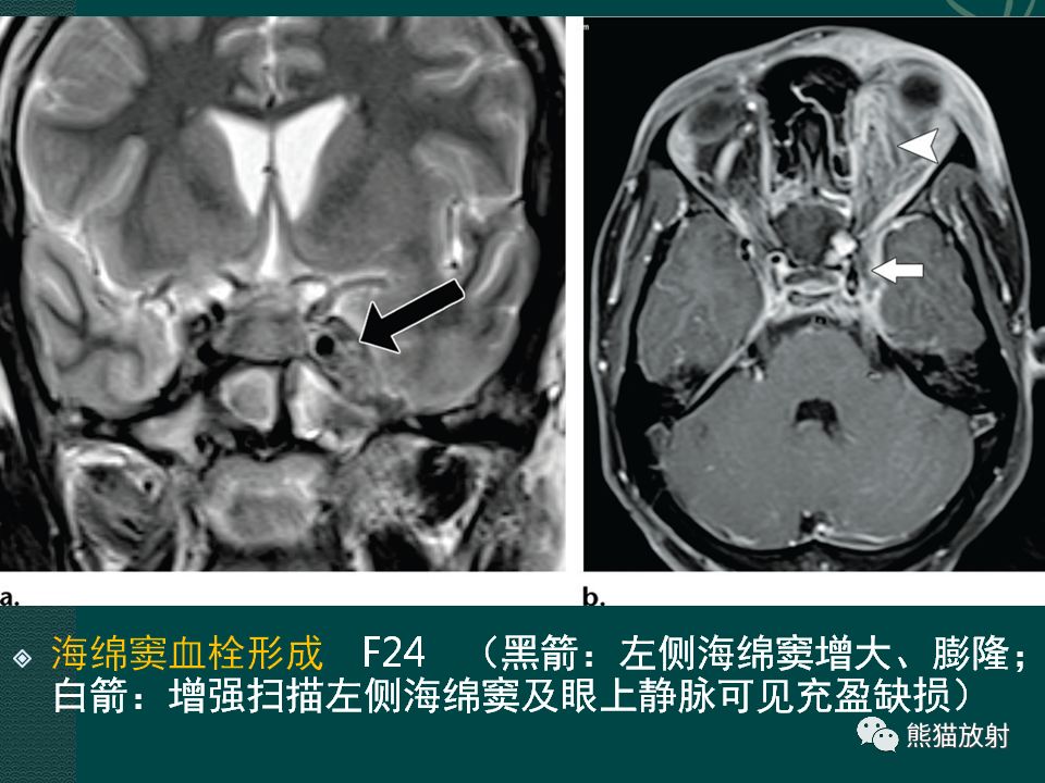 【PPT】海绵窦病变的影像表现及鉴别诊断