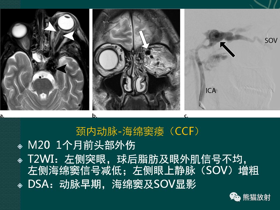 【PPT】海绵窦病变的影像表现及鉴别诊断