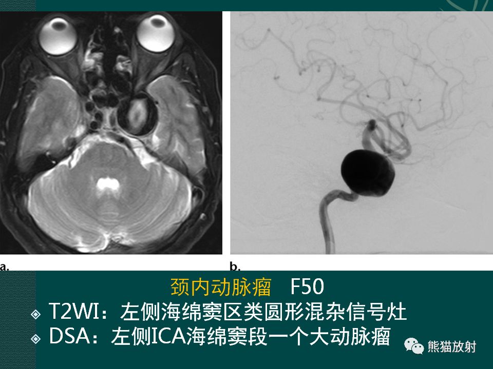 【PPT】海绵窦病变的影像表现及鉴别诊断