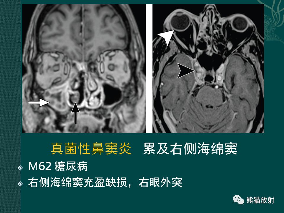 【PPT】海绵窦病变的影像表现及鉴别诊断