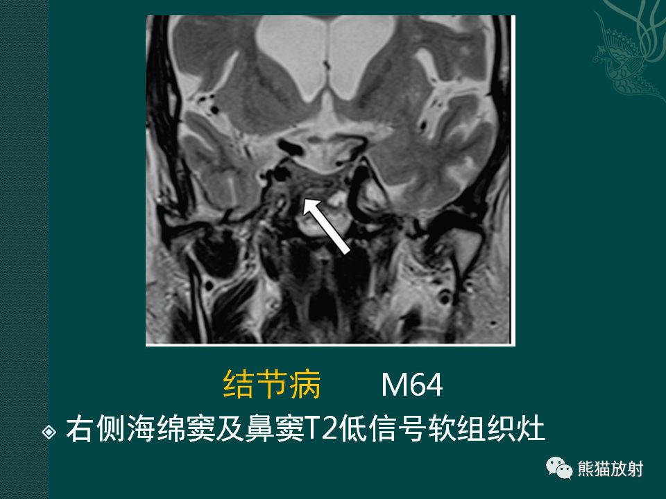 【PPT】海绵窦病变的影像表现及鉴别诊断