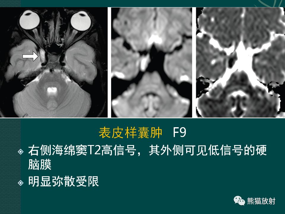 【PPT】海绵窦病变的影像表现及鉴别诊断