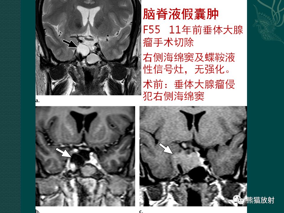 【PPT】海绵窦病变的影像表现及鉴别诊断