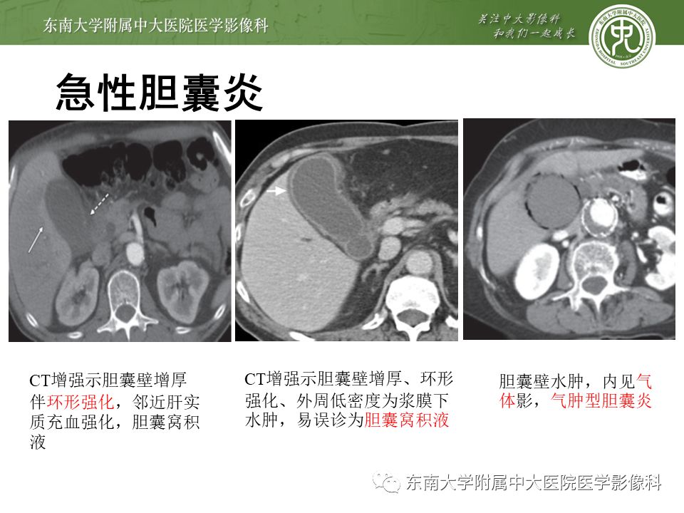 【PPT】胆囊壁增厚性病变