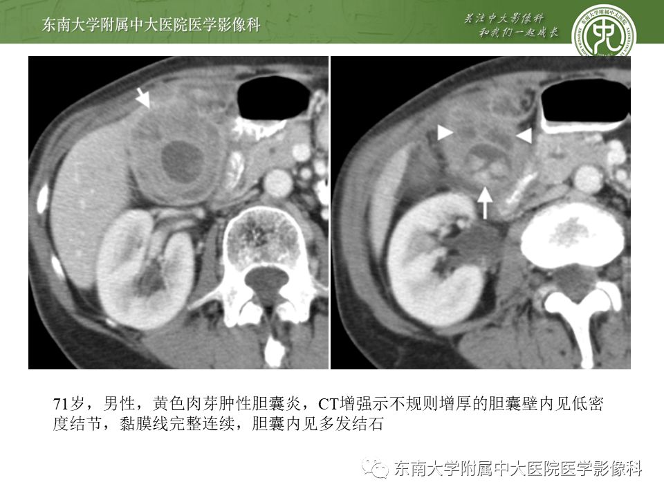 【PPT】胆囊壁增厚性病变