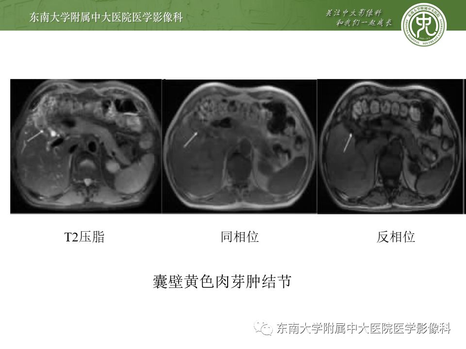 【PPT】胆囊壁增厚性病变