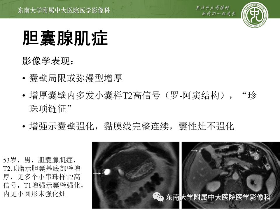 【PPT】胆囊壁增厚性病变