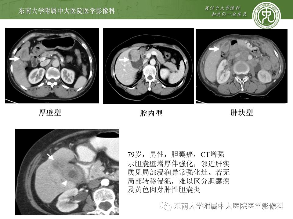 【PPT】胆囊壁增厚性病变