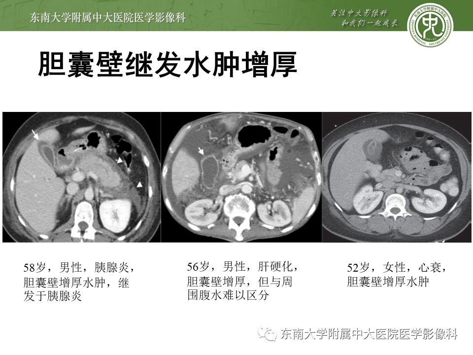 【PPT】胆囊壁增厚性病变