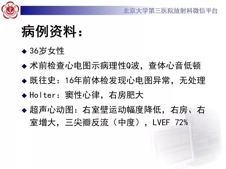 【病例】致心律失常性右室心肌病
